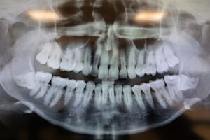 an xray of a dental patient that needs a wisdom teeth extraction.