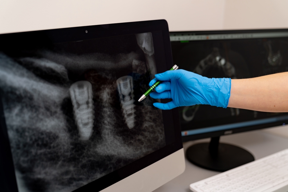 Patient consultation on full mouth dental implants in a modern dental office